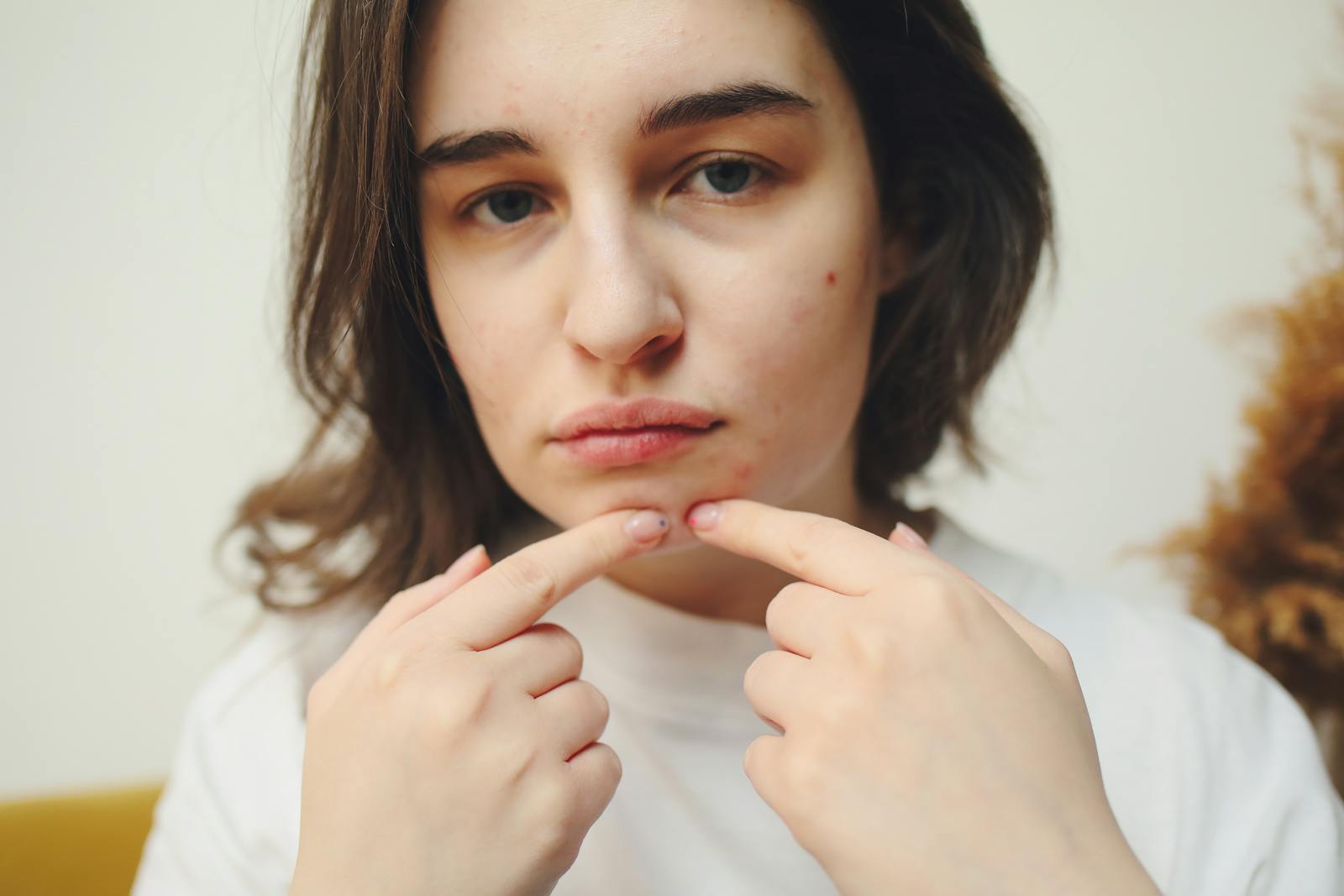 Teen Booked Her Own Dermatologist Appointment for Severe Acne Two Months in Advance — Her Mom Hung Up on the Confirmation Call With Five Seconds to Spare and Told Her to “Deal With It”